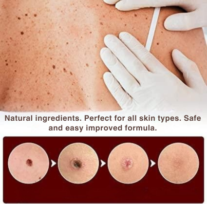 Topical Wart & Skin Tag Care Pen with Precision Applicator – 3 ml