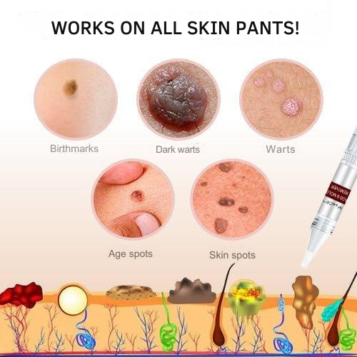 Topical Wart & Skin Tag Care Pen with Precision Applicator – 3 ml